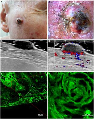 An overview of cutaneous squamous cell carcinoma imaging diagnosis methods